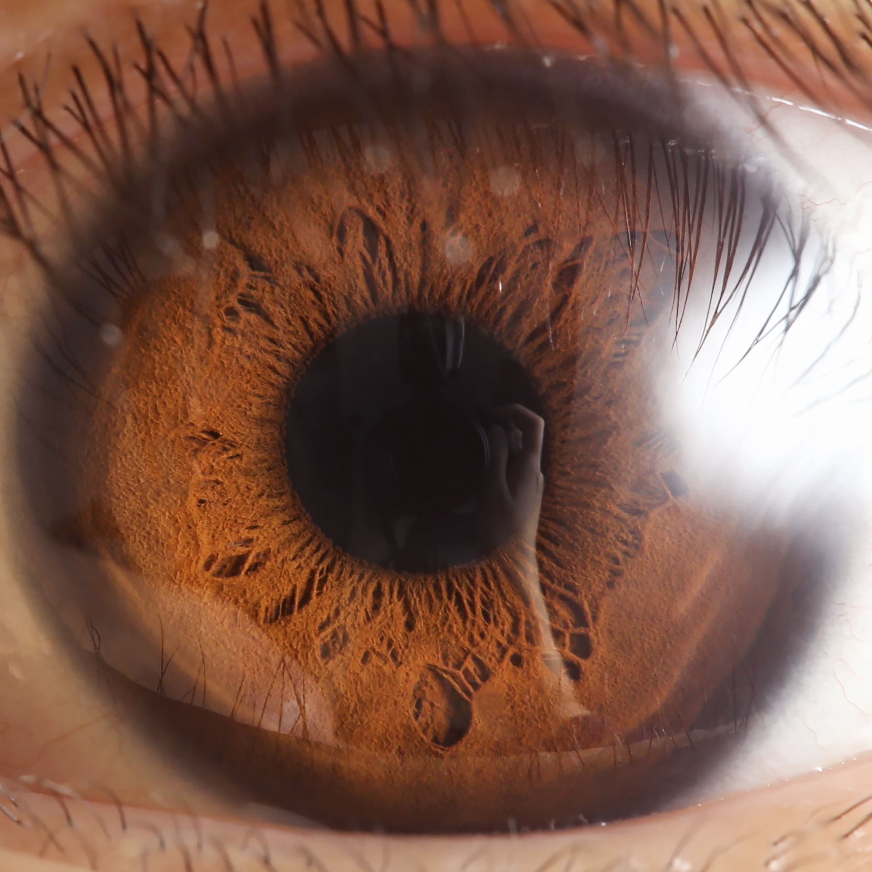Close-up anterior view of a human eye showing cornea, iris, and pupil