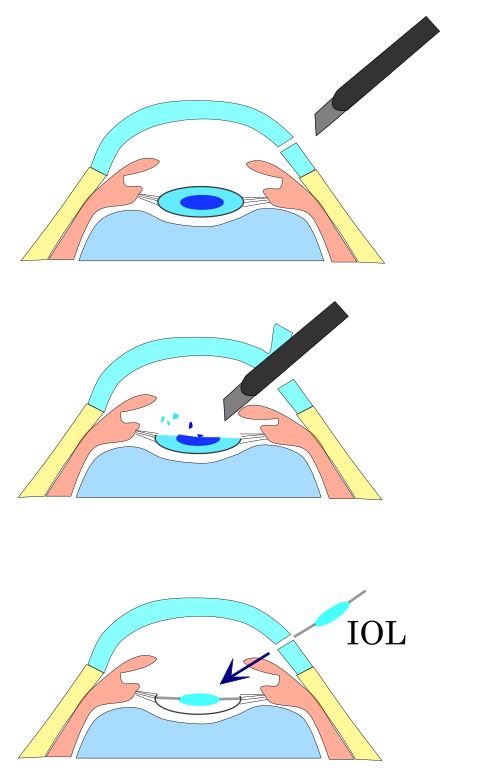 Illustration of cataract removal and IOL placement