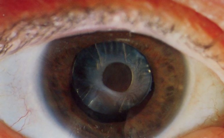 Anterior capsular opacification around an intraocular lens