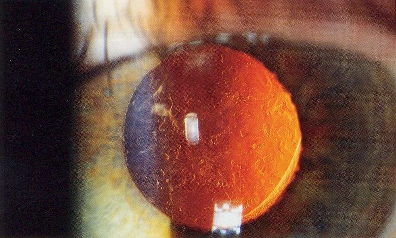 Posterior capsule opacification seen through a dilated pupil